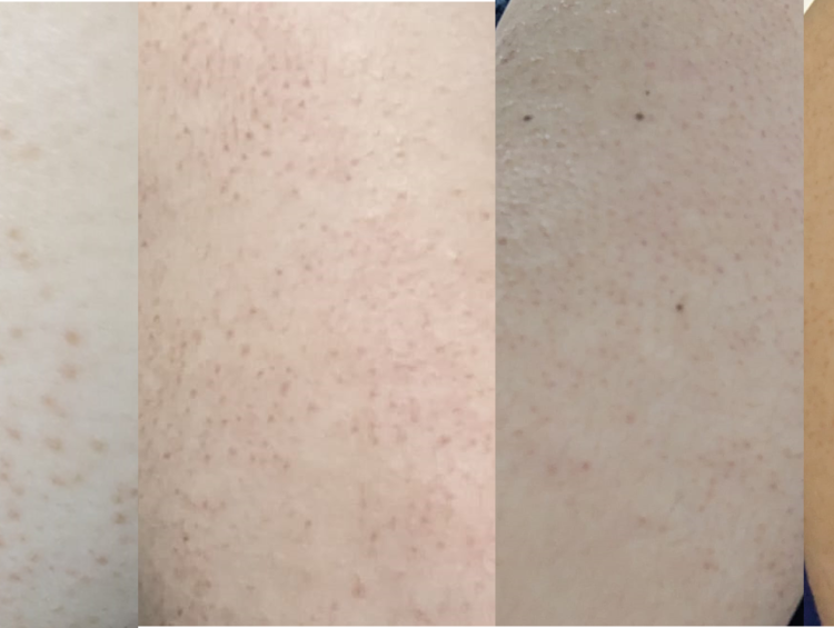 How I Improved Keratosis Pilaris Condition on My Arms 1 the before and after images show different types of acne